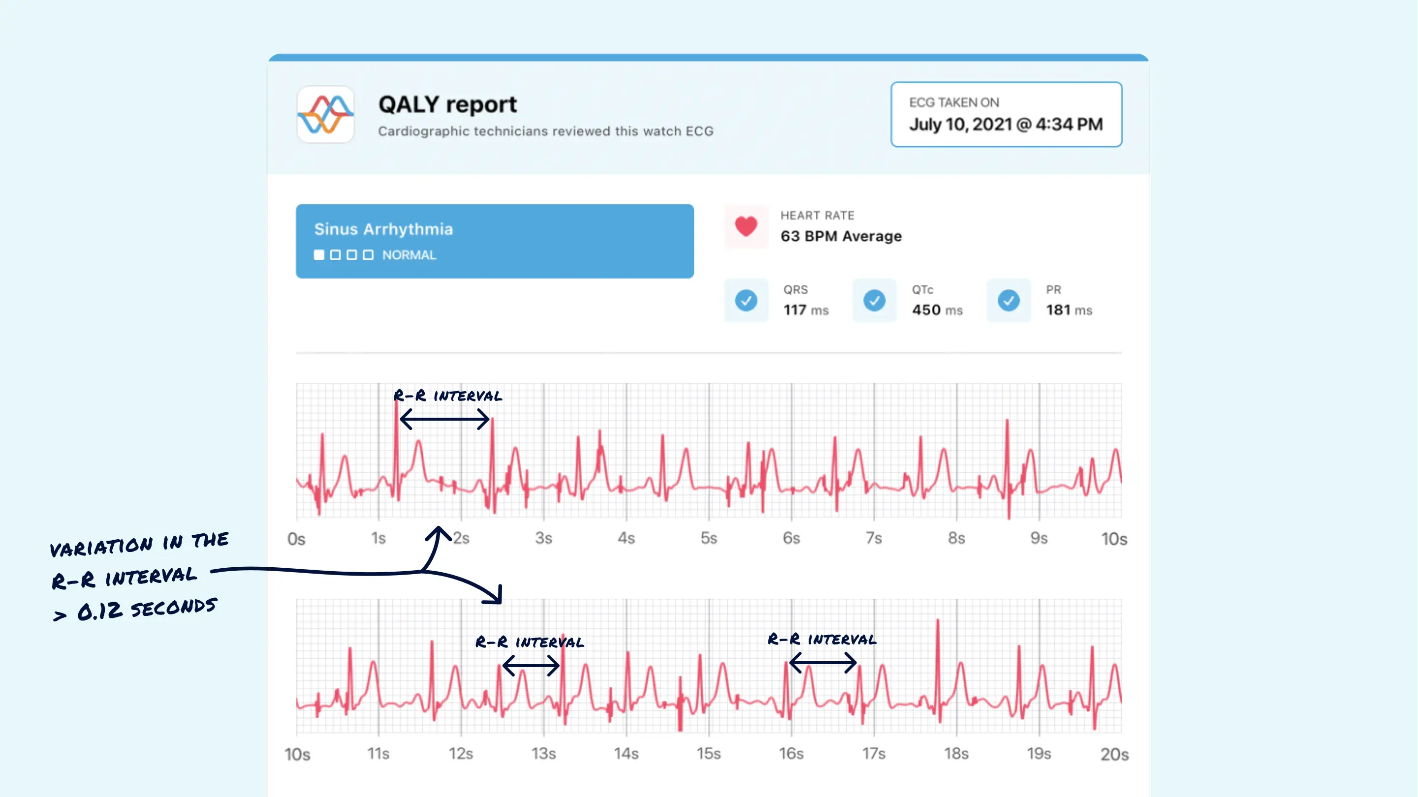 What Sinus Arrhythmia Looks Like on Your Watch ECG Qaly